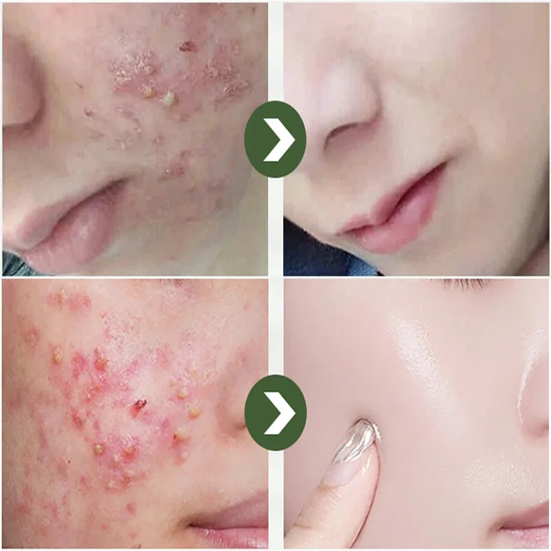 remove acne redness
