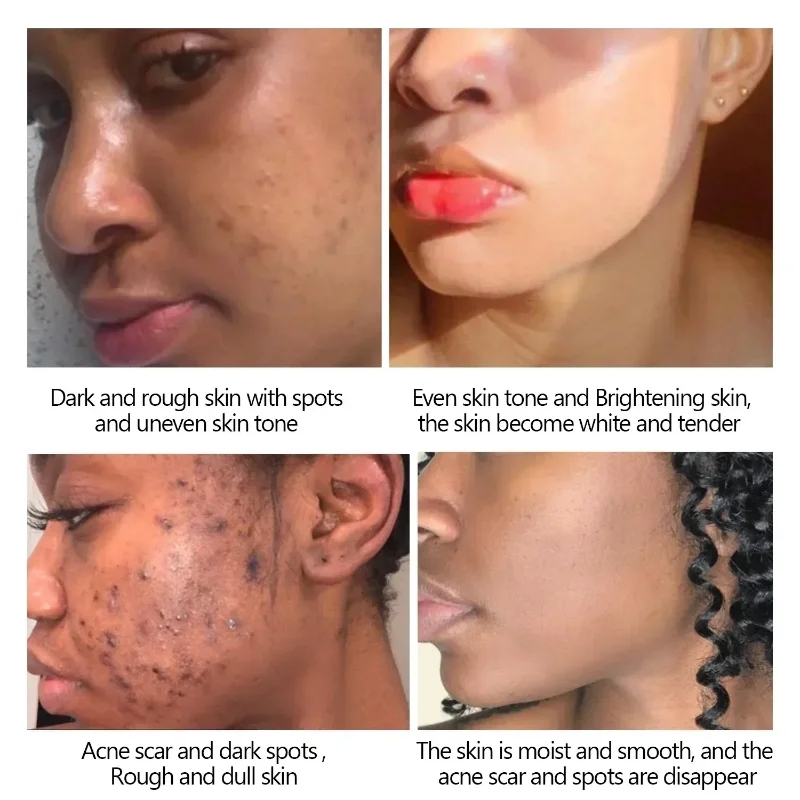 treat your acne scar (japan sakura cream)